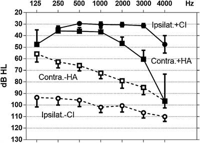 Participation of Acoustic and Electric Hearing in Perceiving Musical Sounds